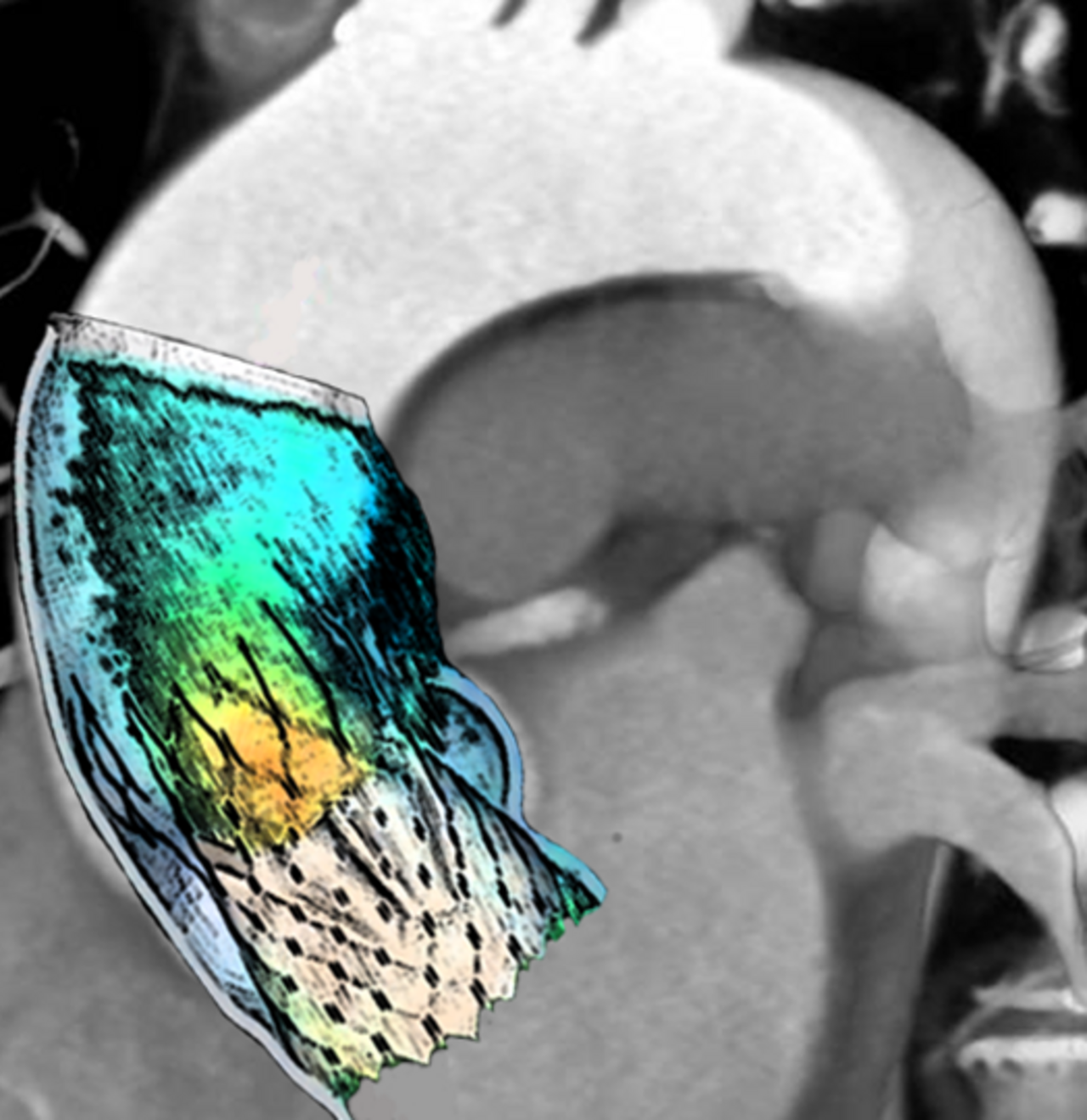 Numerical simulation superimposed on a CT scan image for the TAVI procedure